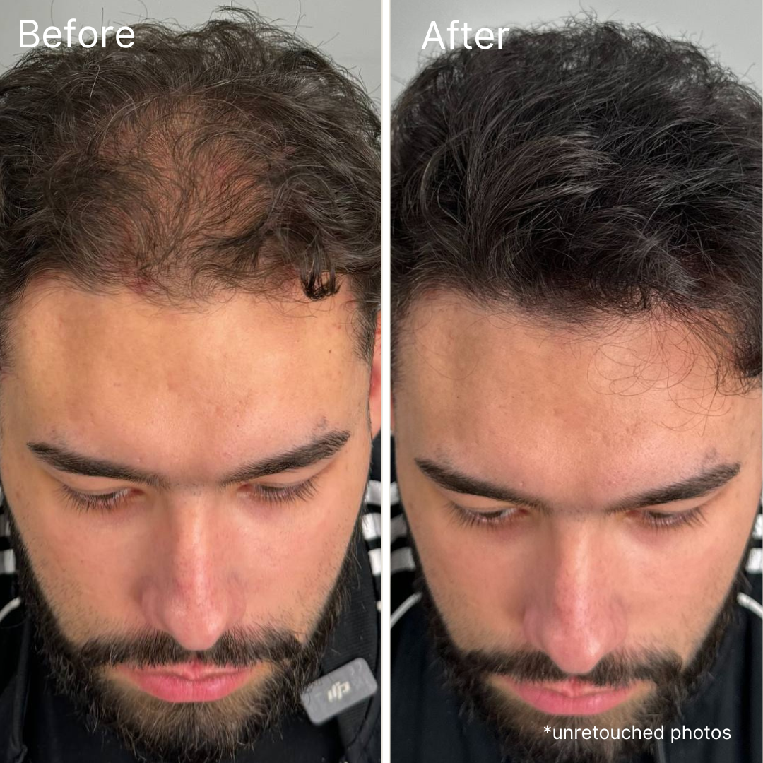 Newyuo™ hair cream 18ml - Instant density effect